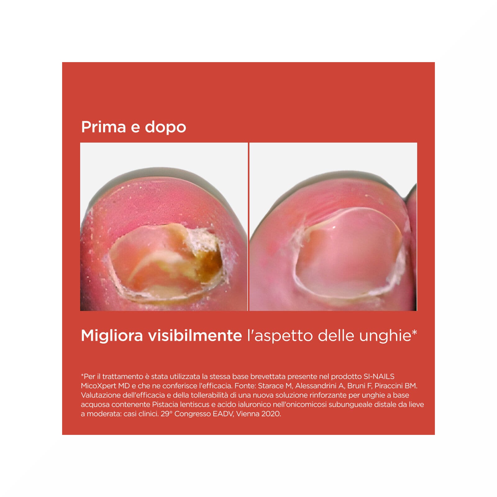 Isdin Si-Nails Micoxpert Md Tratamiento De Uñas Infecciones Por Hongos 4,5ml-5