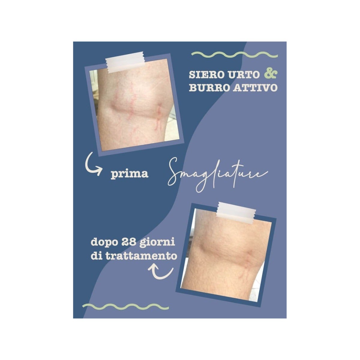 La Saponaria Siero Urto Smagliature 100ml